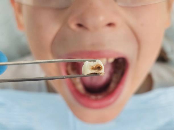 Best Emergency Gum Treatment in London, KY