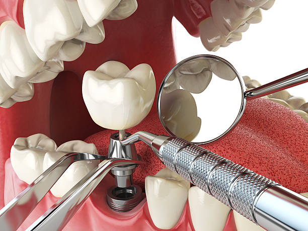 Best Emergency Wisdom Teeth Removal in London, KY