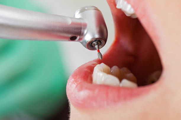 Best Emergency Treatment for Dental Infections or Abscesses in London, KY